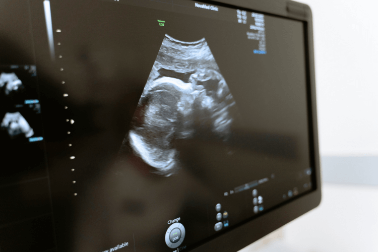 Prenatale testen tijdens de zwangerschap- 20 weken echo